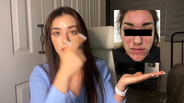 Моя история АКНЕ + Корейский ежедневный уход смотреть онлайн