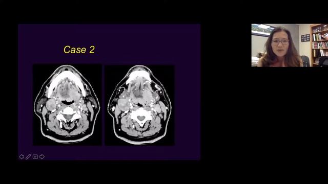 Imaging of Cervical Lymph Nodes Part 2 Health4theworld Academy смотреть онлайн