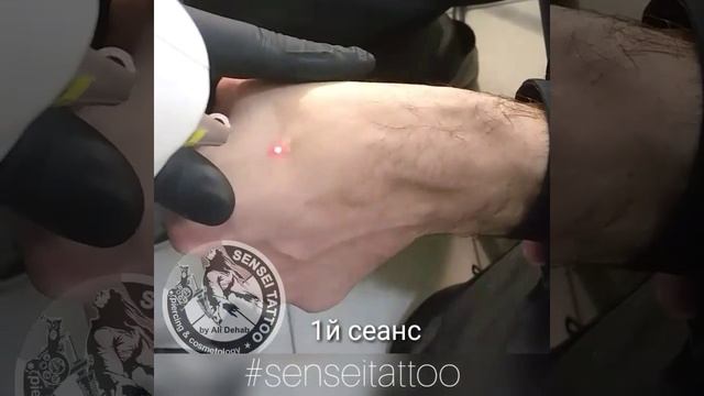 Удалить армейские наколки, партаки лазером в Днепре смотреть онлайн