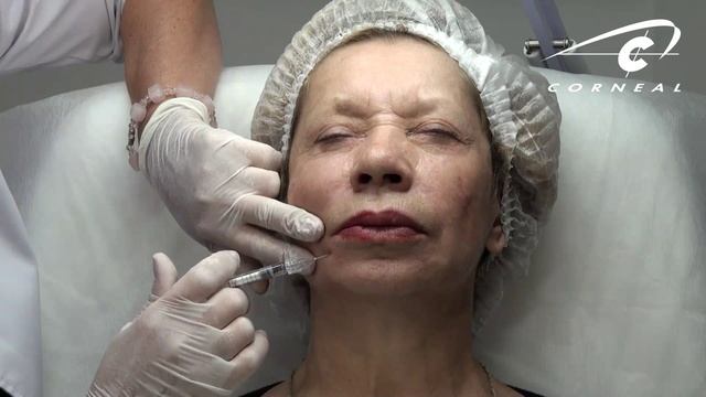 Иглой, как ластиком, стираем морщины