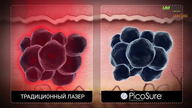 Cynosure Picosure PicoSure - первый в мире эстетический пикосекундный лазер для удаления татуировок смотреть онлайн