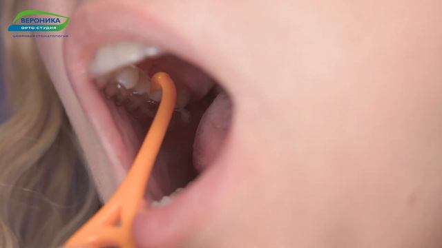 Как надевать и снимать элайнеры смотреть онлайн