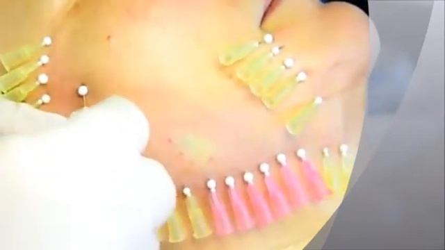 Тредлифтинг PLLA + биоревитализация DMAE