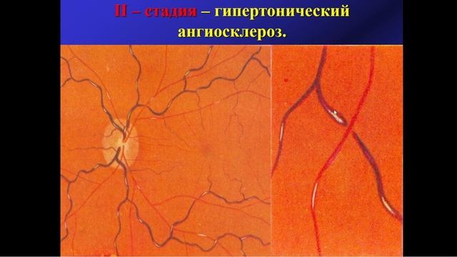 9:50 лекция№8 Изменения органа зрения при общих заболеваниях смотреть онлайн