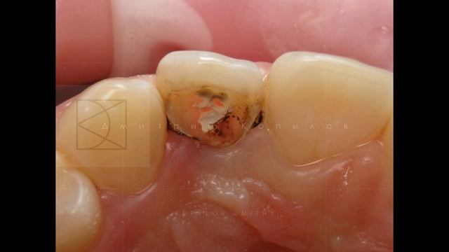 Лечение пульпита без удаления нерва. Лечение глубокого кариеса.  Копылов Дмитрий.  Deep Caries.
