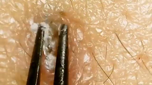EXTRACTION OF INGROWN HAIRS-satisfying -ASMR