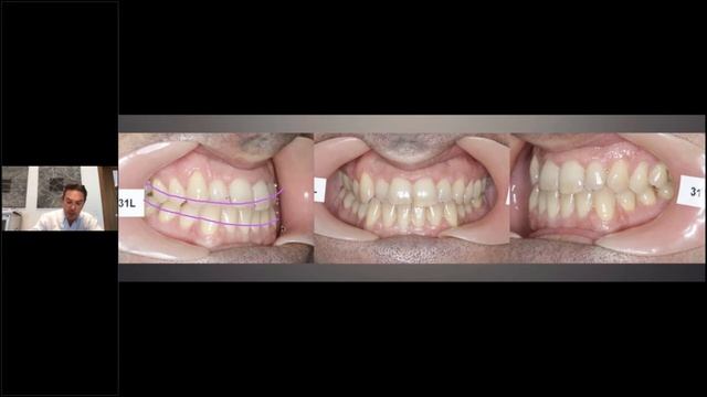 Брекеты Carriere SLX 3D: Новый стандарт эстетического самолигирования!