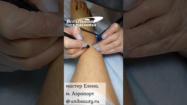 Электроэпиляция волос на голени смотреть онлайн