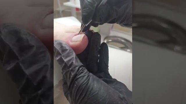 Вросший ноготь лечение смотреть онлайн