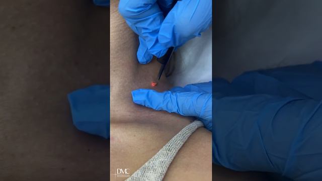 Лазерное удаление папилломатозного дермального невуса! смотреть онлайн