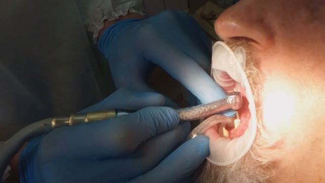 Пациент "А". "Все на 4-х".2-я часть. Протезирование на имплантатах мегаджен. 4-я стоматология. смотреть онлайн