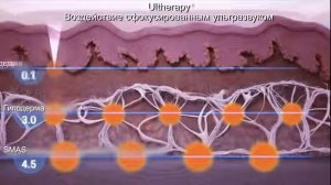СМАС лифтинг лица Что это? Как СМАС лифтинг аппаратный влияет на подтяжку лица.