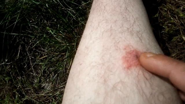 Как выглядит укус клеща? смотреть онлайн