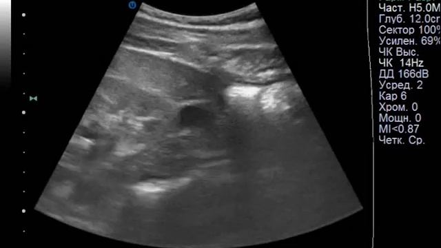 Кавернозная лимфангиома брыжейки смотреть онлайн