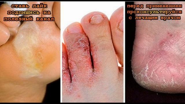 ★ Как избежать заражения грибком стопы: важно знать всем, кто собрался в отпуск! смотреть онлайн