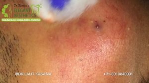 BLACKHEAD REMOVAL PART-1 (20-10-2018) BY DR.LALIT KASANA