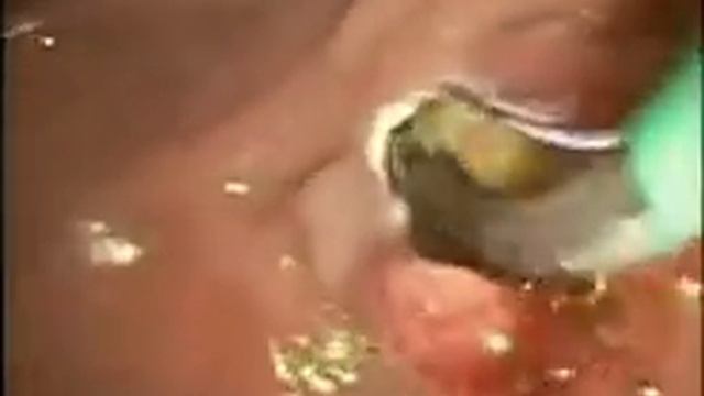 14.2-1 Сфинктеротомия и удаление камней