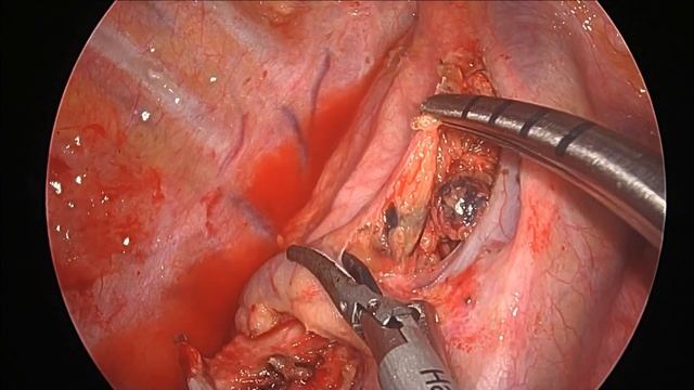 【#5】Uniportal VATS, right upper mediastinal lymph node dissection (#2R and #4R) after RUL смотреть онлайн