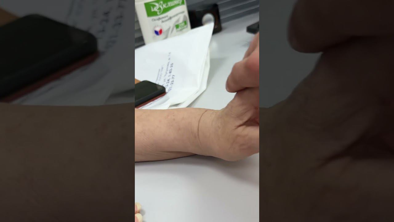 Перелом Лучевой кости с Грубым смещением | Как работает рука? смотреть онлайн