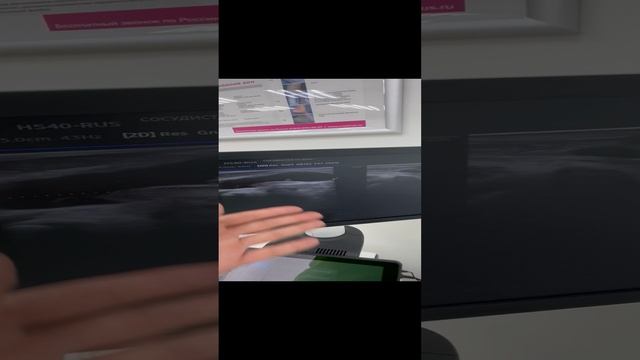 Киста Бейкера, случайная находка. Узи сосудов. Сосудистый хирург. Флеболог. Флеболог Москва смотреть онлайн