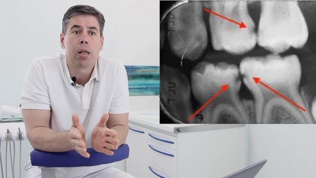 Как самому обнаружить кариес? Информация для любознательных!