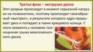 Что такое экструзия межпозвоночного диска?