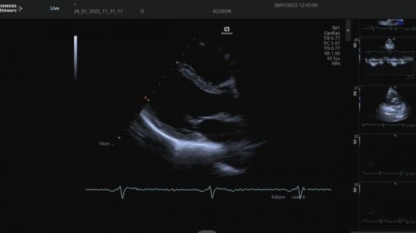 US_ACUSON Redwood.mp4