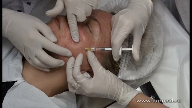 Биоревитализация - мелкопапульно и часто смотреть онлайн