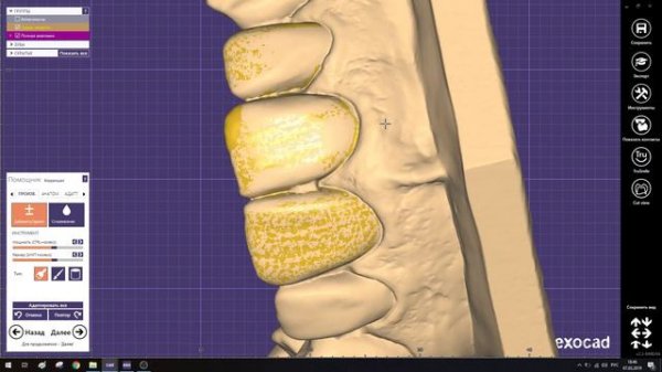 Виртуальное препарирование Shell exocad