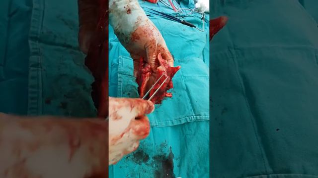 Обширный рак гортани смотреть онлайн