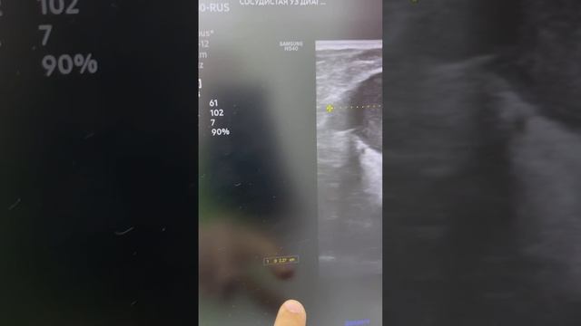 Варикоз на ноге. Как лечить варикоз? Лечкние варикоза. Планируем операцию. Флеболог Москва. Флеболог смотреть онлайн