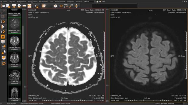 Ирина Трофименко. Дифференциальная диагностика ишемического инфаркта смотреть онлайн