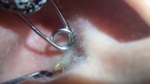 Удаление твердого прыща из уха