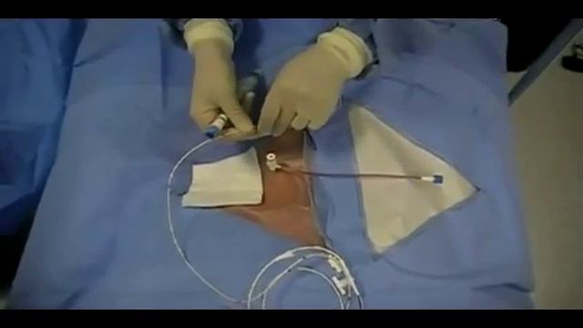 Аритмология Внешний кардиостимулятор Insertion of Transvenous Pacemaker смотреть онлайн