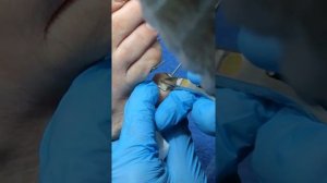 Удаление стержневой мозоли