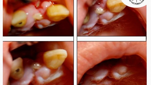 Методика удаления корня зуба, которую нельзя применять. смотреть онлайн