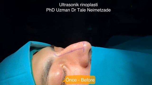 Ultrasonik rinoplasti / PhD Uzman Dr Tale Neimetzade смотреть онлайн