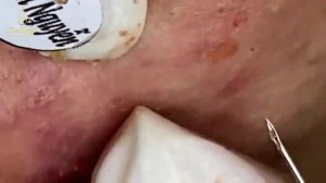 акне,удаление черных точек