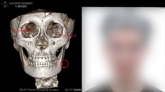 Should I have bimaxillary surgery for my asymmetry? смотреть онлайн
