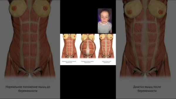 Диастаз. Диастаз и массаж