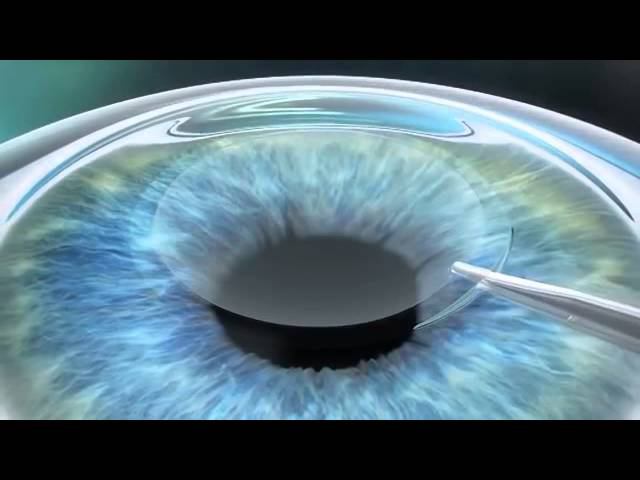 Бесконтактная коррекция зрения. Фемтолазер VisuMax смотреть онлайн