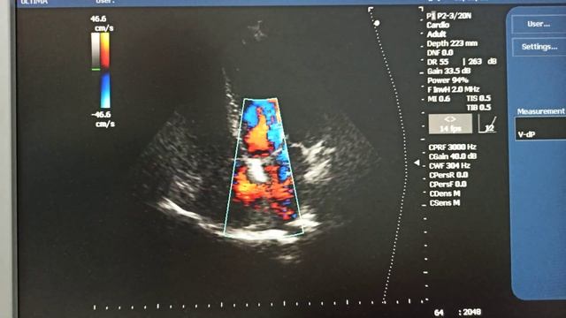 Двухстворчатый аортальный клапан Стеноз легочной артерии Открытое овальное окно и др смотреть онлайн