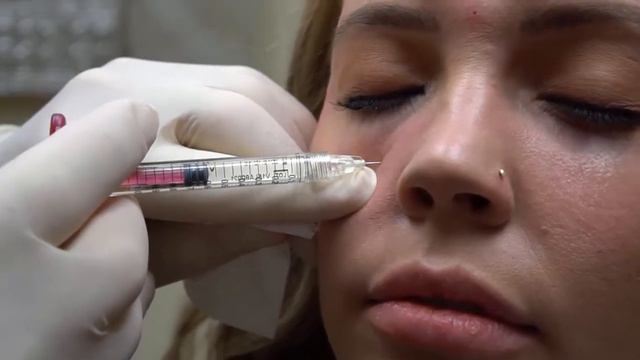 Under eye treatment with Juvederm Volbella filler - Paragon Medspa Southlake, Texas смотреть онлайн