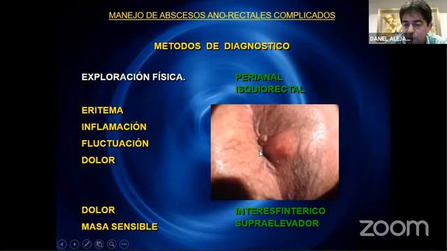 Absceso y fístula anorrectal Dr. Daniel Guerra Melgar смотреть онлайн