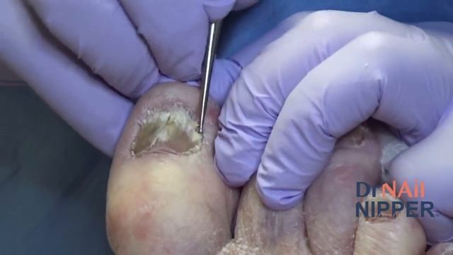 Fungal Toenails In The Podiatry Office, Part 1 (2021)