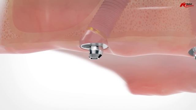 All-on-4® treatment concept | Nobel Biocare смотреть онлайн