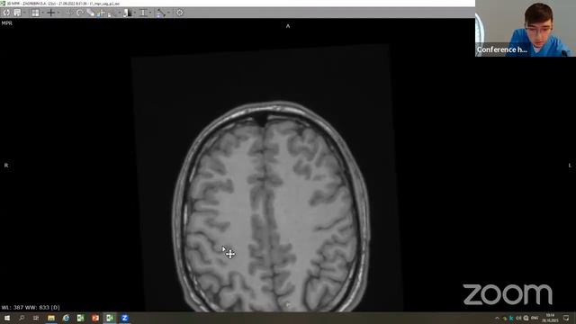Neurosurgical Case Report (FCN, Tyumen, Russia) смотреть онлайн