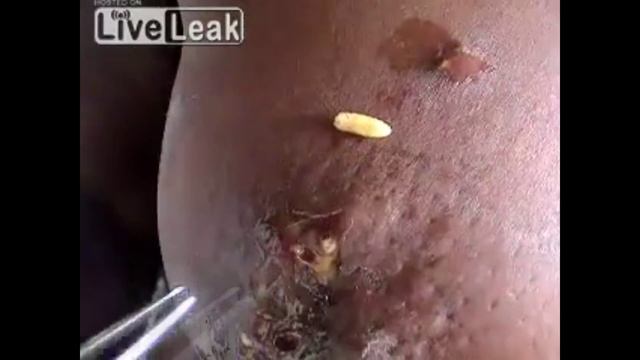 Опарыши в человеке смотреть онлайн