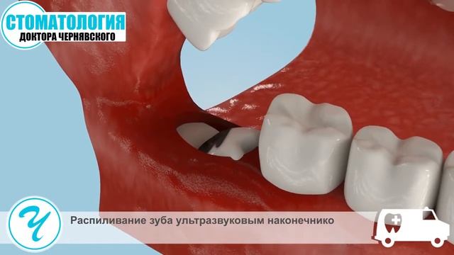 Удаление зуба мудрости без боли. Атравматичный метод. смотреть онлайн