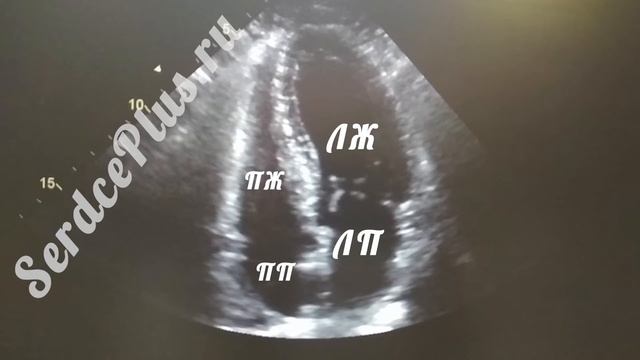 Узи сердца. Нормальная фракция выброса левого желудочка смотреть онлайн